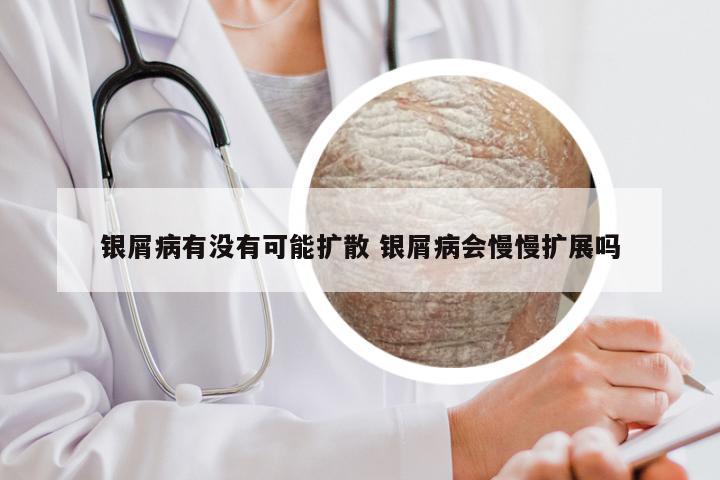 银屑病有没有可能扩散 银屑病会慢慢扩展吗