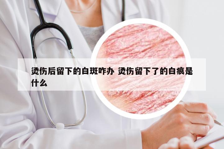 烫伤后留下的白斑咋办 烫伤留下了的白痕是什么