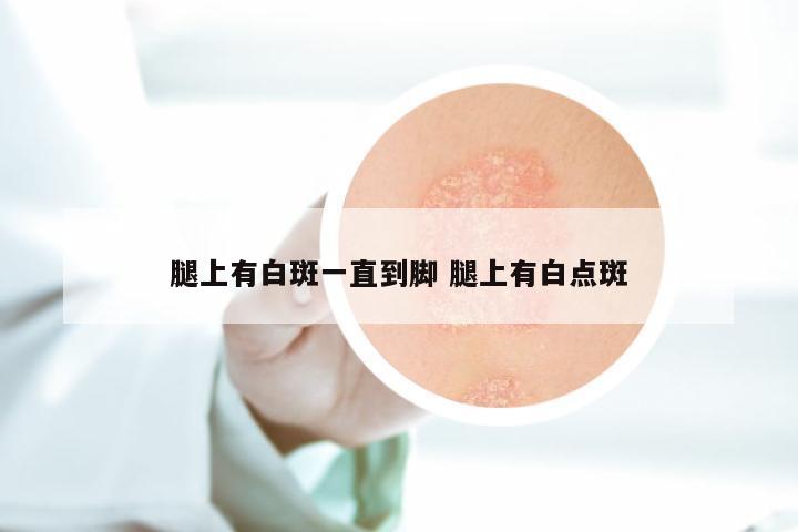 腿上有白斑一直到脚 腿上有白点斑