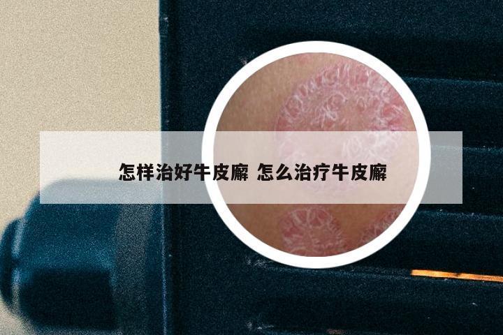 怎样治好牛皮廨 怎么治疗牛皮廨