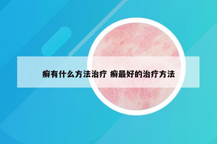 癣有什么方法治疗 癣最好的治疗方法