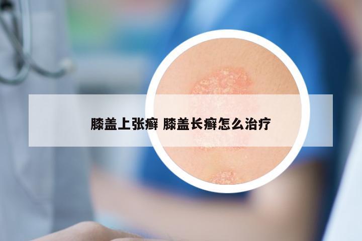 膝盖上张癣 膝盖长癣怎么治疗