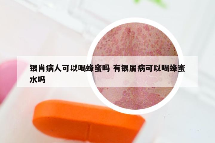 银肖病人可以喝蜂蜜吗 有银屑病可以喝蜂蜜水吗