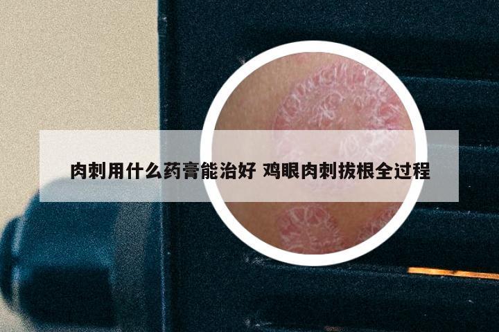 肉刺用什么药膏能治好 鸡眼肉刺拔根全过程