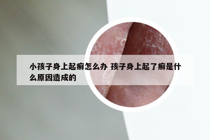 小孩子身上起癣怎么办 孩子身上起了癣是什么原因造成的