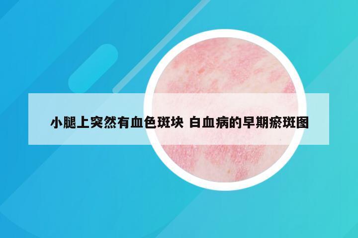 小腿上突然有血色斑块 白血病的早期瘀斑图