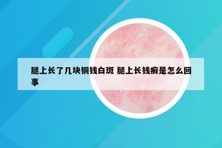 腿上长了几块铜钱白斑 腿上长钱癣是怎么回事