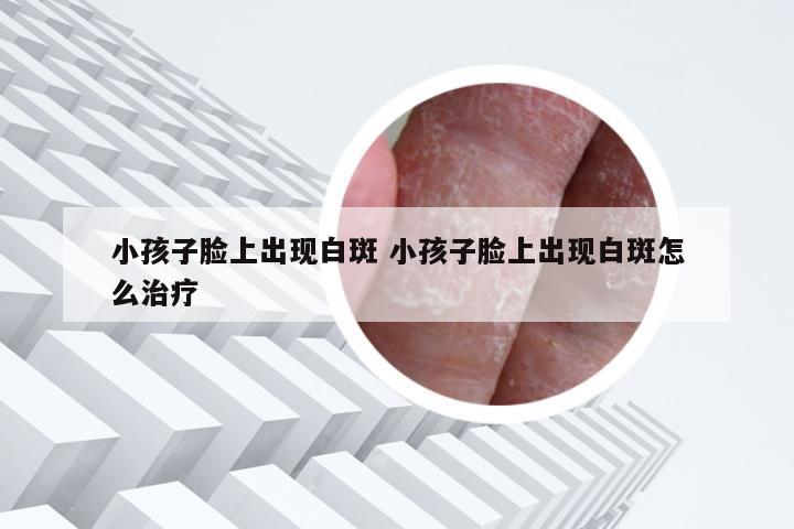 小孩子脸上出现白斑 小孩子脸上出现白斑怎么治疗