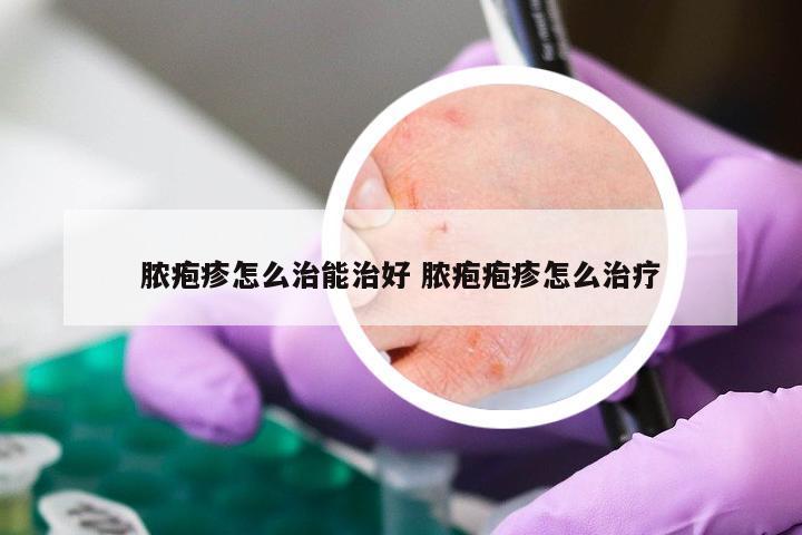 脓疱疹怎么治能治好 脓疱疱疹怎么治疗