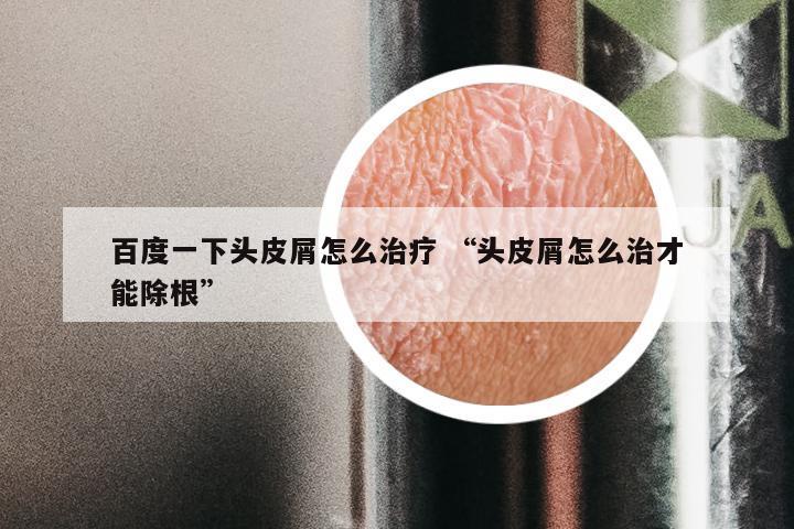 百度一下头皮屑怎么治疗 “头皮屑怎么治才能除根”