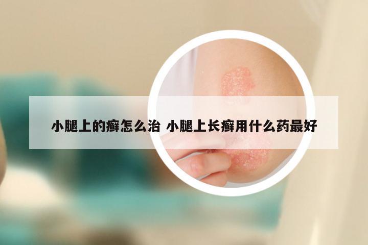 小腿上的癣怎么治 小腿上长癣用什么药最好