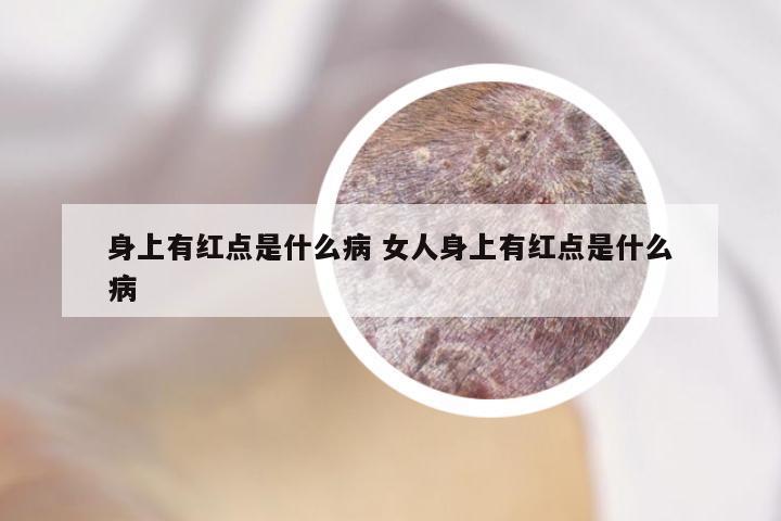 身上有红点是什么病 女人身上有红点是什么病