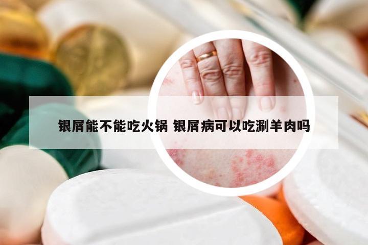 银屑能不能吃火锅 银屑病可以吃涮羊肉吗