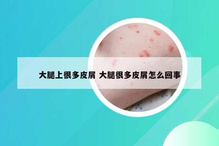 大腿上很多皮屑 大腿很多皮屑怎么回事