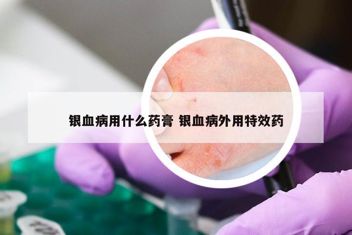 银血病用什么药膏 银血病外用特效药