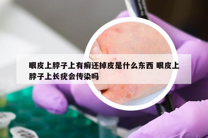 眼皮上脖子上有癣还掉皮是什么东西 眼皮上脖子上长疣会传染吗