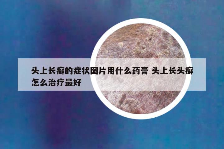 头上长癣的症状图片用什么药膏 头上长头癣怎么治疗最好