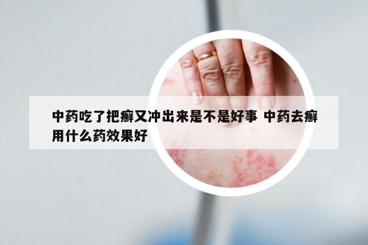 中药吃了把癣又冲出来是不是好事 中药去癣用什么药效果好