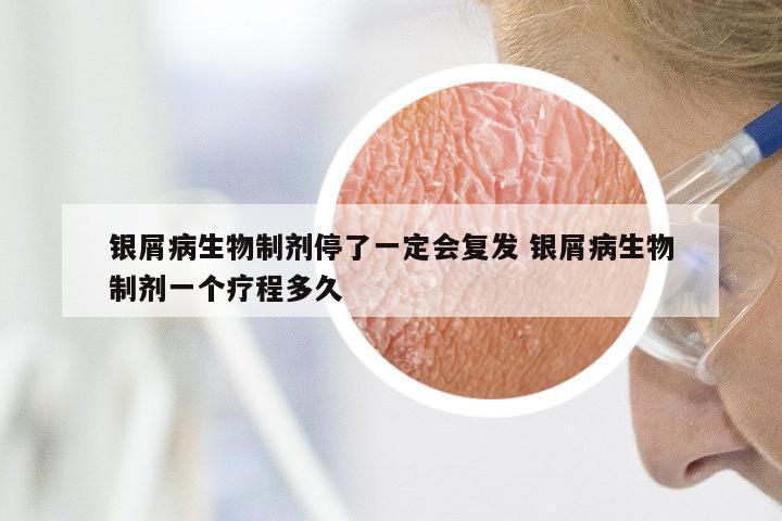 银屑病生物制剂停了一定会复发 银屑病生物制剂一个疗程多久