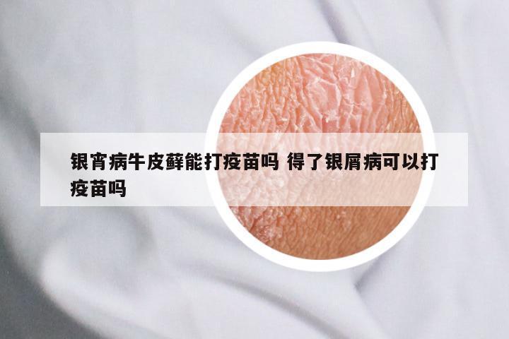 银宵病牛皮藓能打疫苗吗 得了银屑病可以打疫苗吗