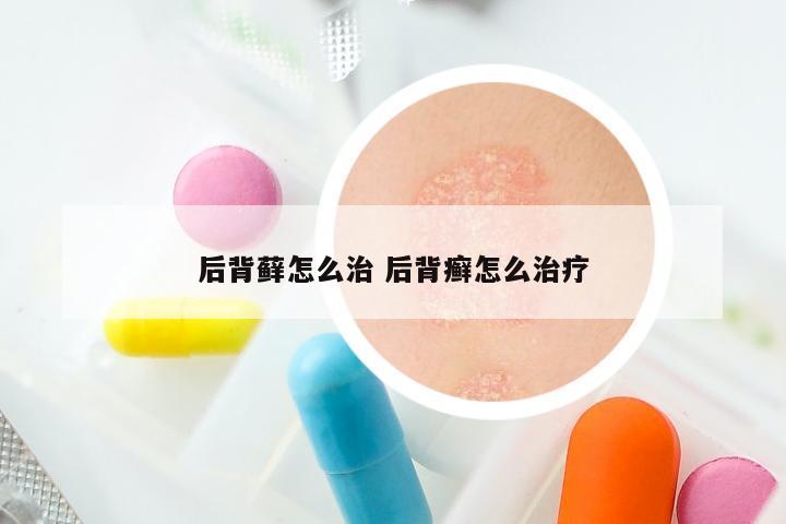 后背藓怎么治 后背癣怎么治疗