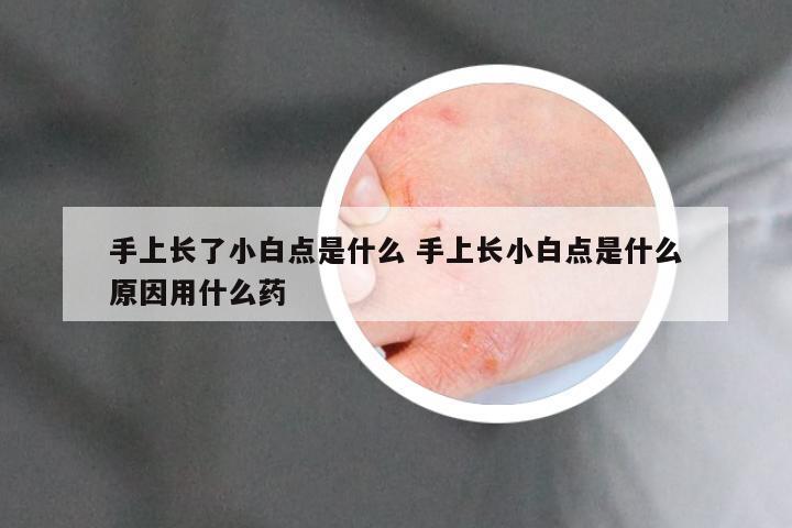 手上长了小白点是什么 手上长小白点是什么原因用什么药