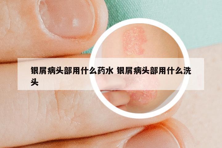 银屑病头部用什么药水 银屑病头部用什么洗头