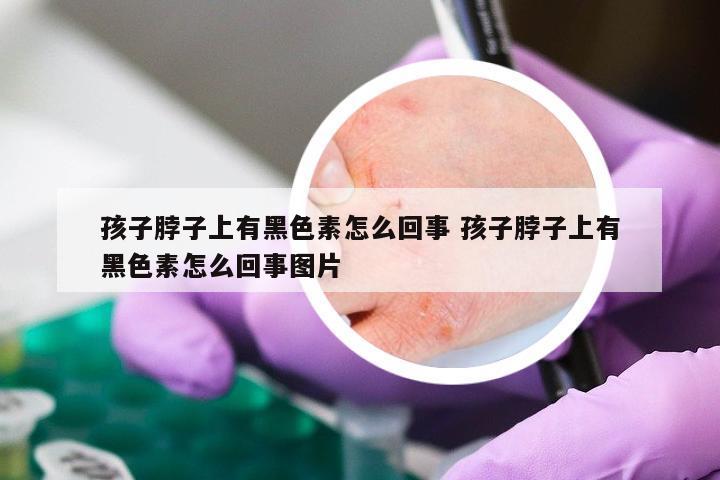 孩子脖子上有黑色素怎么回事 孩子脖子上有黑色素怎么回事图片