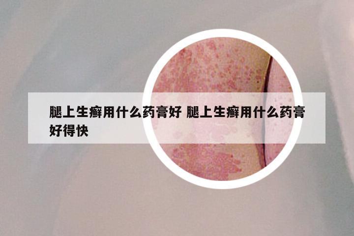 腿上生癣用什么药膏好 腿上生癣用什么药膏好得快