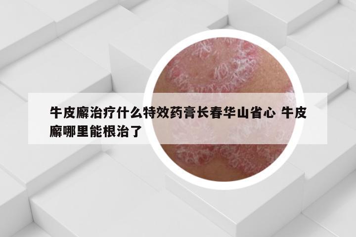 牛皮廨治疗什么特效药膏长春华山省心 牛皮廨哪里能根治了