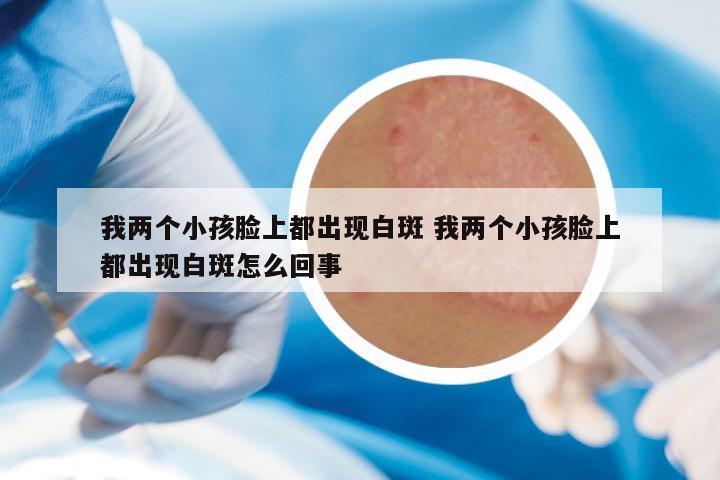 我两个小孩脸上都出现白斑 我两个小孩脸上都出现白斑怎么回事