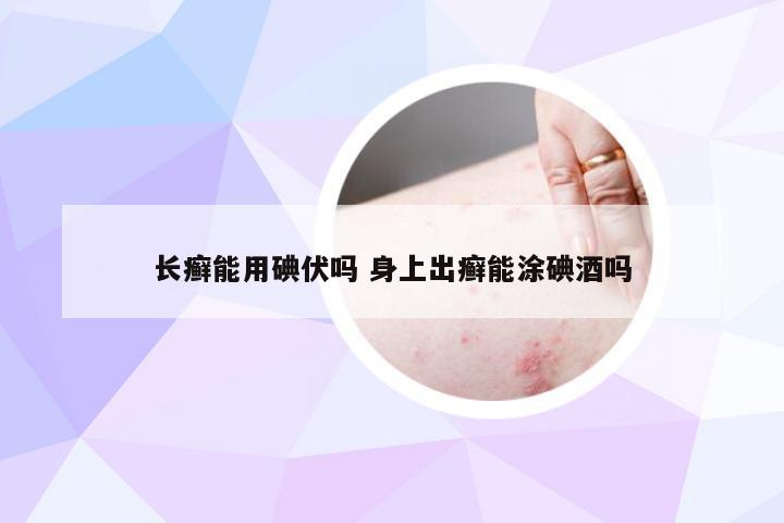 长癣能用碘伏吗 身上出癣能涂碘酒吗