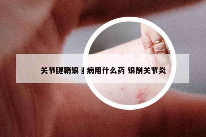 关节腱鞘银趐病用什么药 银削关节炎