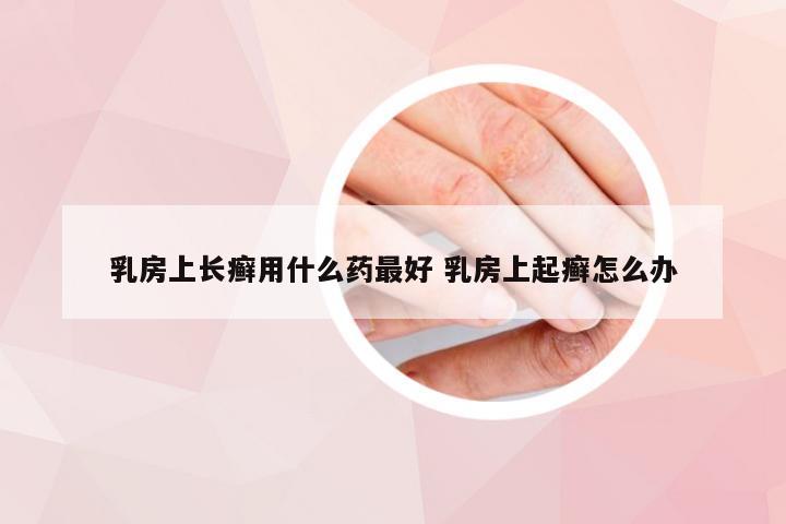 乳房上长癣用什么药最好 乳房上起癣怎么办