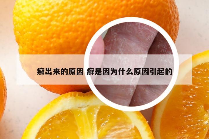 癣出来的原因 癣是因为什么原因引起的