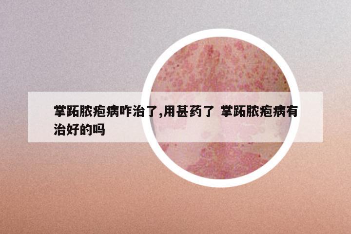 掌跖脓疱病咋治了,用甚药了 掌跖脓疱病有治好的吗