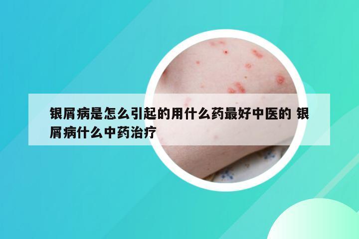 银屑病是怎么引起的用什么药最好中医的 银屑病什么中药治疗