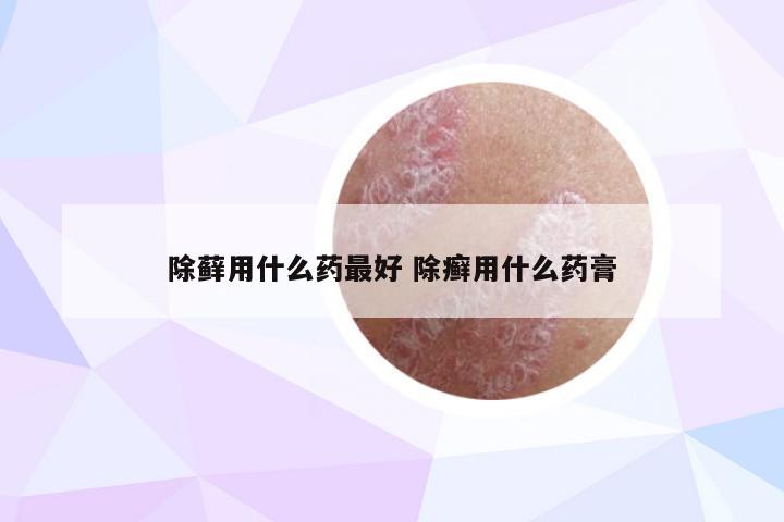 除藓用什么药最好 除癣用什么药膏