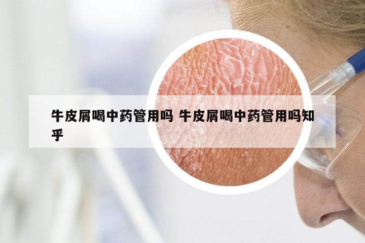 牛皮屑喝中药管用吗 牛皮屑喝中药管用吗知乎