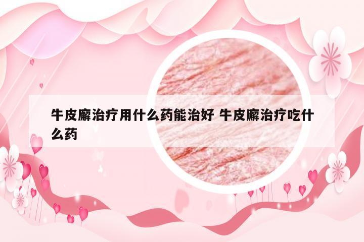 牛皮廨治疗用什么药能治好 牛皮廨治疗吃什么药