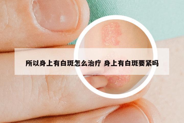 所以身上有白斑怎么治疗 身上有白斑要紧吗