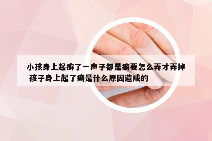 小孩身上起癣了一声子都是癣要怎么弄才弄掉 孩子身上起了癣是什么原因造成的