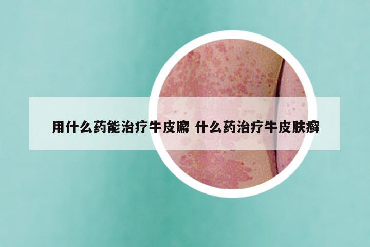 用什么药能治疗牛皮廨 什么药治疗牛皮肤癣