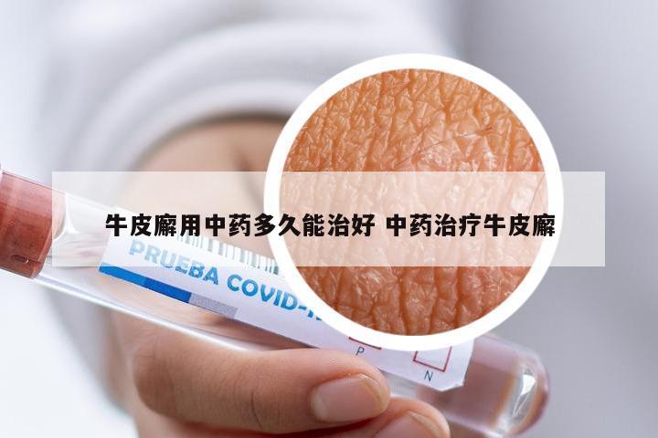 牛皮廨用中药多久能治好 中药治疗牛皮廨