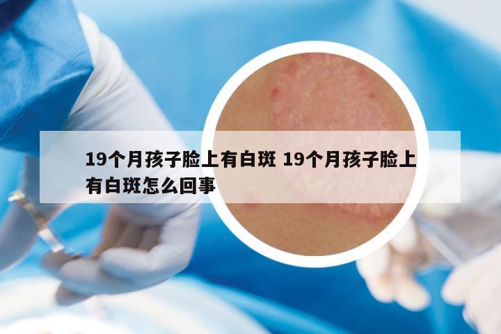 19个月孩子脸上有白斑 19个月孩子脸上有白斑怎么回事