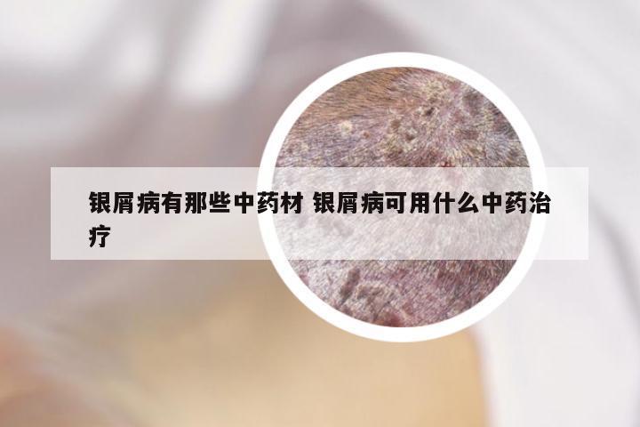 银屑病有那些中药材 银屑病可用什么中药治疗