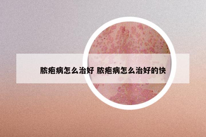 脓疱病怎么治好 脓疱病怎么治好的快