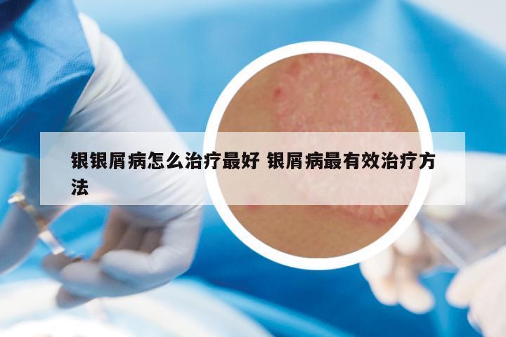 银银屑病怎么治疗最好 银屑病最有效治疗方法