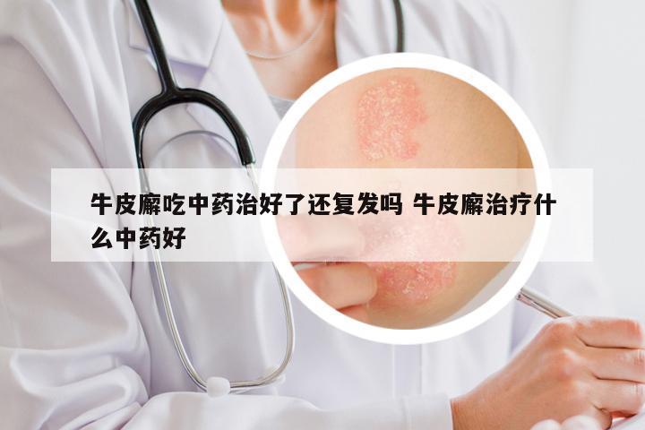 牛皮廨吃中药治好了还复发吗 牛皮廨治疗什么中药好