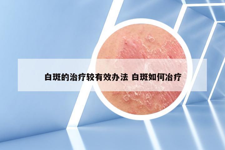 白斑的治疗较有效办法 白斑如何冶疗